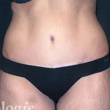 After: Tummy Tuck, Dr. Zach Barnes