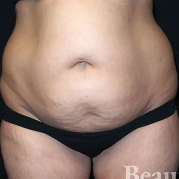 Before: Tummy Tuck, Dr. Zach Barnes
