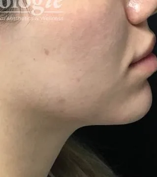 After: Fillers, Beautologie Medical Aesthetics