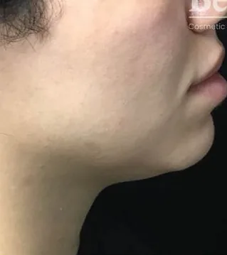 Before: Fillers, Beautologie Medical Aesthetics