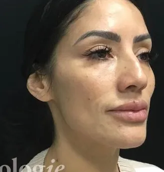 After: Fillers, Beautologie Medical Aesthetics