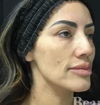 Before: Fillers, Beautologie Medical Aesthetics