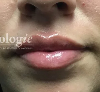 After: Lip Fillers, Beautologie Medical Aesthetics