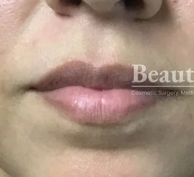 Before: Lip Fillers, Beautologie Medical Aesthetics