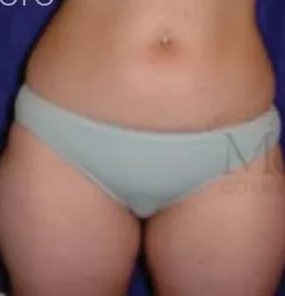 Before: Liposuction, Dr. Thomas McNemar