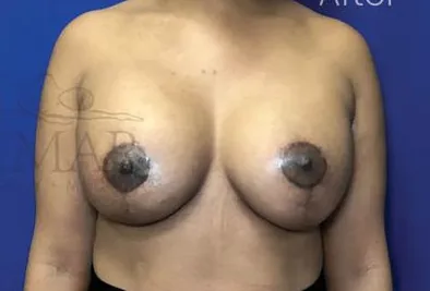 After: Breast Lift, Dr. Thomas McNemar