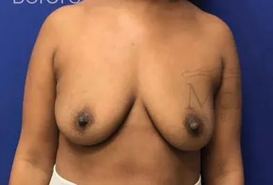 Before: Breast Lift, Dr. Thomas McNemar