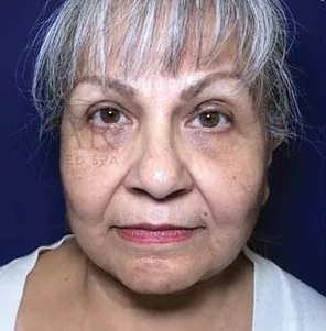 After: Facelift, Dr. Thomas McNemar