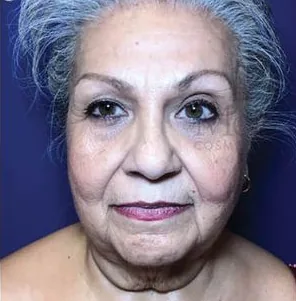 Before: Facelift, Dr. Thomas McNemar