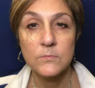 After: Facelift, Dr. Thomas McNemar