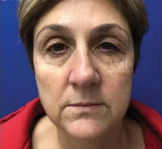 Before: Facelift, Dr. Thomas McNemar