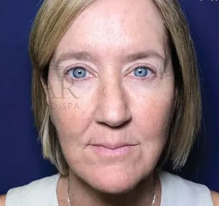 After: Facelift, Dr. Thomas McNemar