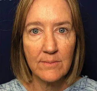 Before: Facelift, Dr. Thomas McNemar