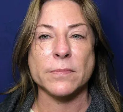 After: Buccal Pad Removal, Dr. Thomas McNemar
