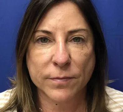 Before: Buccal Pad Removal, Dr. Thomas McNemar