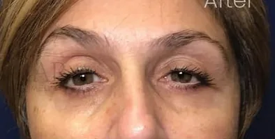 After: Eyelid Surgery, Dr. Thomas McNemar
