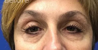 Before: Eyelid Surgery, Dr. Thomas McNemar