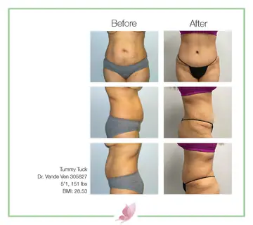 Before and after: Tummy Tuck, Dr. Heather Vande Ven