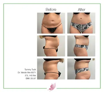 Before and after: Tummy Tuck, Dr. Heather Vande Ven