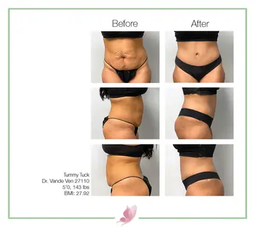 Before and after: Tummy Tuck, Dr. Heather Vande Ven