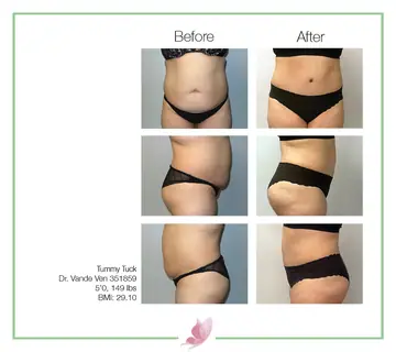 Before and after: Tummy Tuck, Dr. Heather Vande Ven