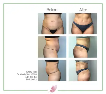 Before and after: Tummy Tuck, Dr. Heather Vande Ven