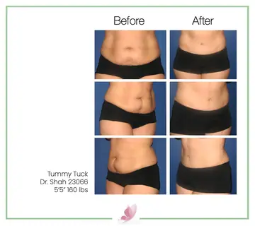 Before and after: Tummy Tuck, Dr. Darshan R. Shah