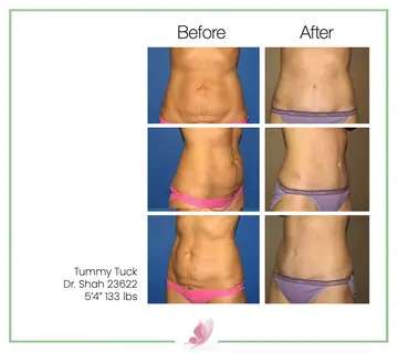 Before and after: Tummy Tuck, Dr. Darshan R. Shah