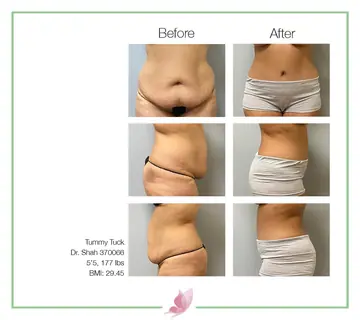 Before and after: Tummy Tuck, Dr. Darshan R. Shah