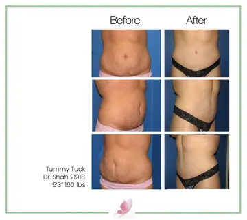 Before and after: Tummy Tuck, Dr. Darshan R. Shah