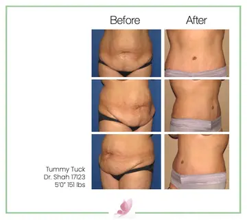 Before and after: Tummy Tuck, Dr. Darshan R. Shah