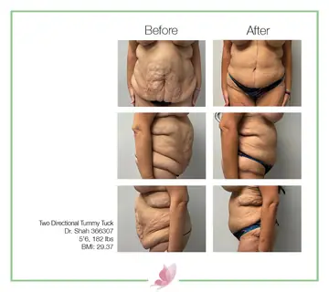 Before and after: Reverse Tummy Tuck, Dr. Darshan R. Shah