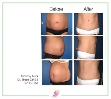 Before and after: Tummy Tuck, Dr. Darshan R. Shah