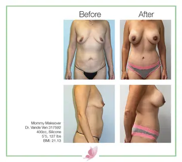 Before and after: Mommy Makeover, Dr. Heather Vande Ven