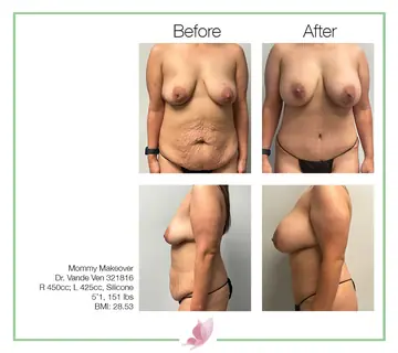 Before and after: Mommy Makeover, Dr. Heather Vande Ven