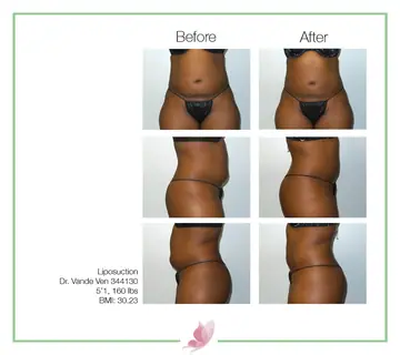 Before and after: Liposuction, Dr. Heather Vande Ven