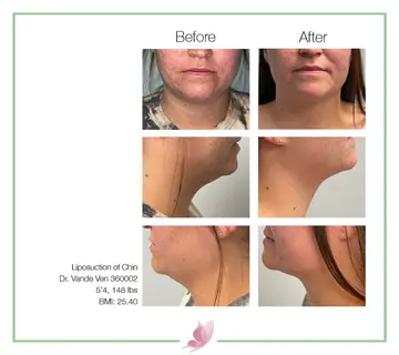 Before and after: Liposuction, Dr. Heather Vande Ven