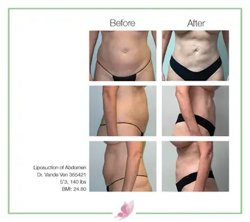 Before and after: Liposuction, Dr. Heather Vande Ven