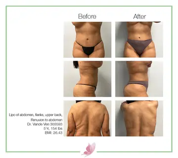 Before and after: Liposuction, Dr. Heather Vande Ven