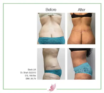 Before and after: Back Lift, Dr. Darshan R. Shah