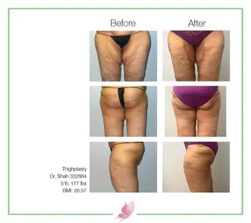 Before and after: Leg Lift, Dr. Darshan R. Shah