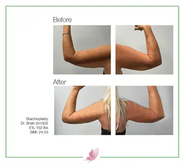 Before and after: Arm Lift, Dr. Darshan R. Shah