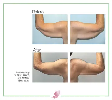 Before and after: Arm Lift, Dr. Darshan R. Shah