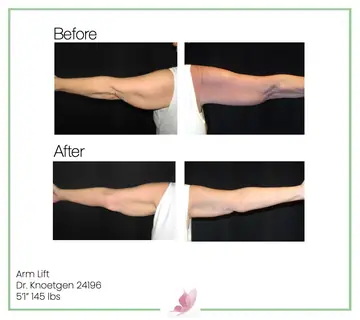 Before and after: Arm Lift, Dr. James Knoetgen