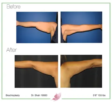 Before and after: Arm Lift, Dr. Darshan R. Shah