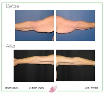 Before and after: Arm Lift, Dr. Darshan R. Shah