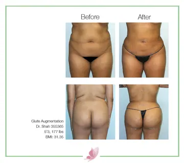 Before and after: Buttock Augmentations, Dr. Darshan R. Shah