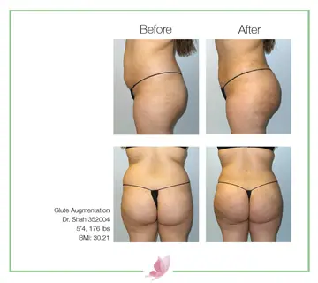 Before and after: Buttock Augmentations, Dr. Darshan R. Shah
