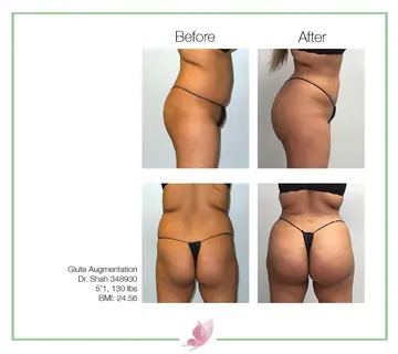 Before and after: Buttock Augmentations, Dr. Darshan R. Shah