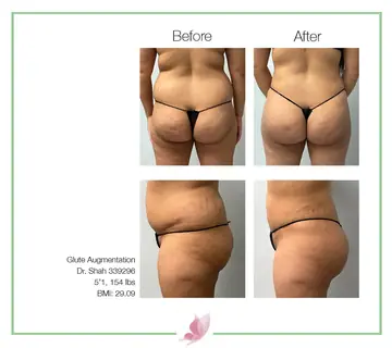 Before and after: Buttock Augmentations, Dr. Darshan R. Shah